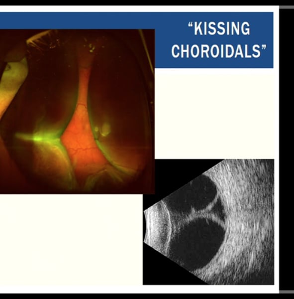 <p>"kissing choroidals"</p>