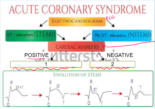 <p>What does it mean if cardiac markers are negative (leading to #2)?</p>
