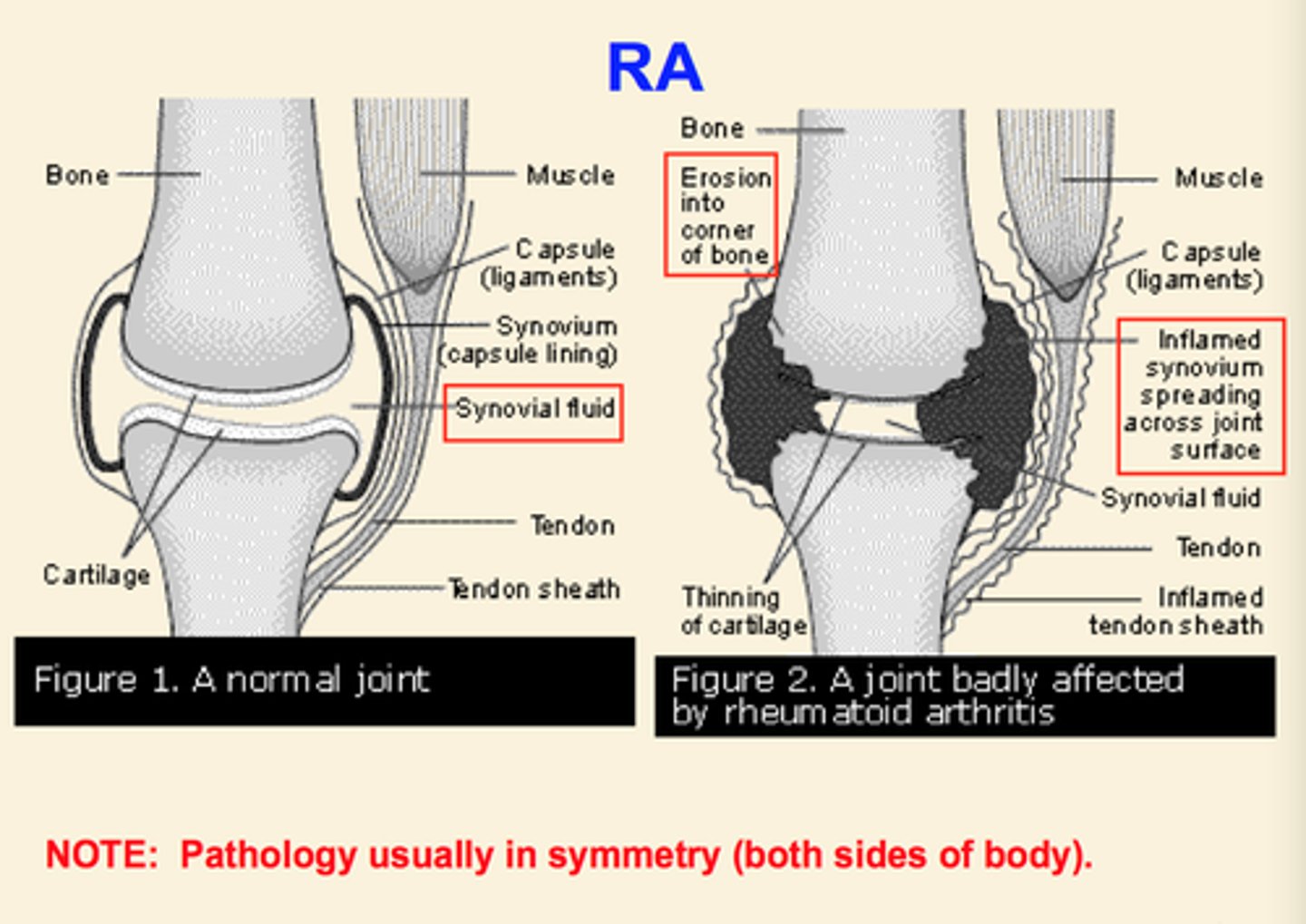 <p>a chronic inflammatory disease characterized by joint swelling, joint tenderness, and destruction of synovial joints - leading to severe disability and premature mortality</p>
