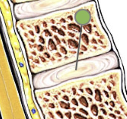 <p>What is the inner gel-like layer of intervertebral discs?</p>