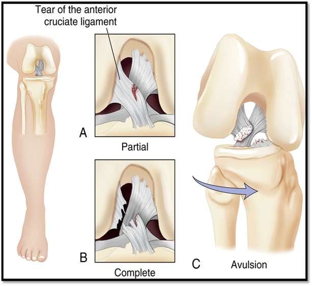 <p><span>Noncontact injuries: when athletes pivots, lands from a jump, or slows down when running</span></p><p></p><p><strong><span>Signs/Symptoms</span></strong><span>: knee twisting, hearing a pop followed by knee pain &amp; swelling</span></p><p></p><p><strong><span>Complications</span></strong><span>: partial or complete tear</span></p><p></p><p><strong><span>Diagnostics</span></strong><span>: MRI, Lachman’s test</span></p><p></p><p><strong><span>Treatment:</span></strong><span> Reconstructive surgery, Rehab with PT, Conservative treatment, aspiration, knee is in brace/immobilizer, ROM</span></p>