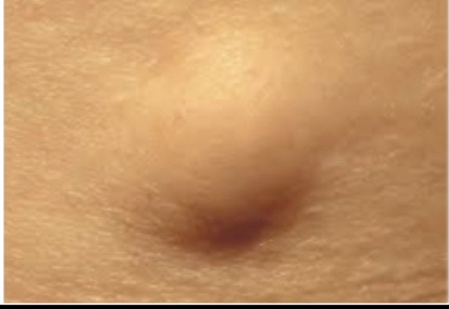 <p>Lipoma</p>