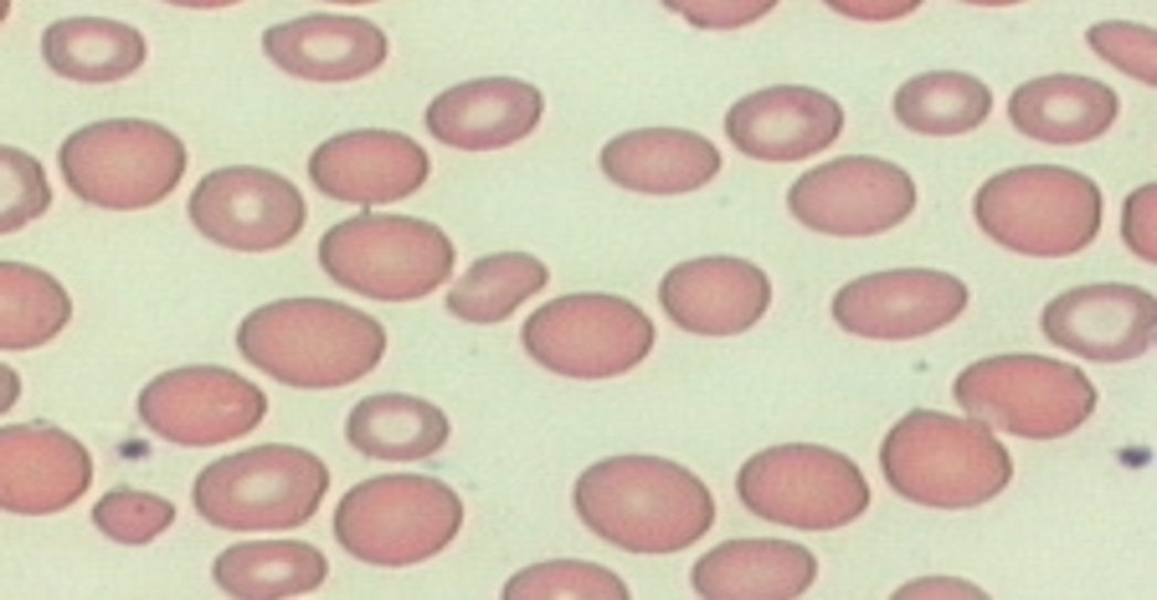 <p>a <span>peripheral smear with a variety of cell sizes</span></p>