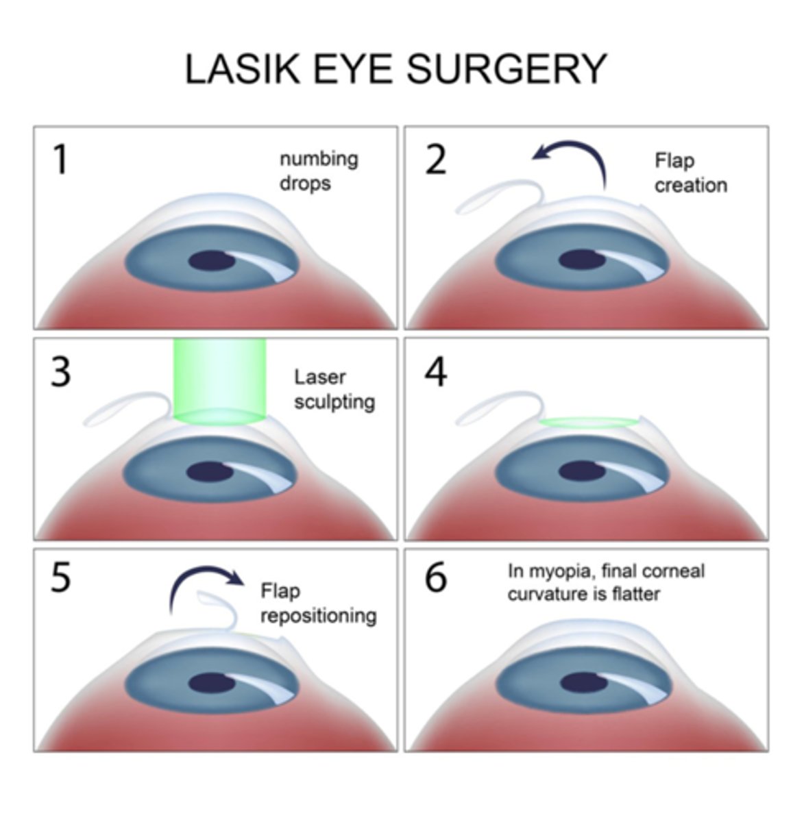 <p>•Keratomileusis comes from Greek words for "cornea" and "to carve"</p><p>•Flap created and folded back</p><p>•Anterior stroma ablated using laser</p><p>•Flap replaced</p>