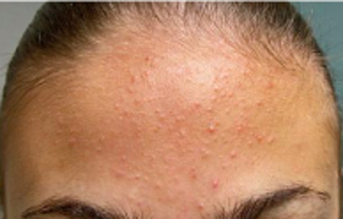<p>Acneiform Disorders:</p><p>noninflammatory, &lt;5 mm, dome-shaped, smooth, skin-colored, whitish, or grayish papules</p>