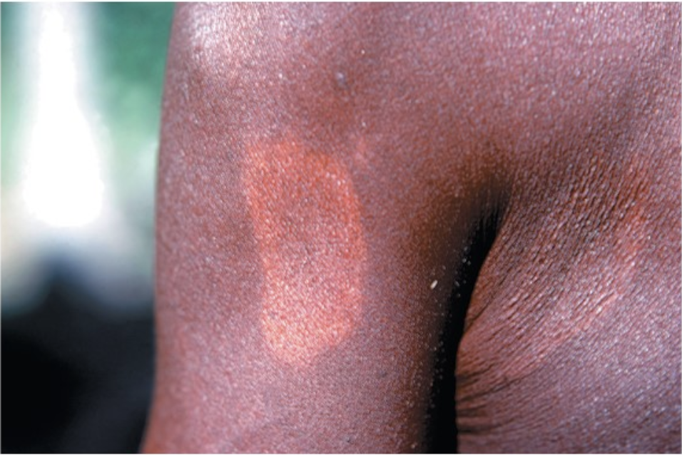 <p>this patient has a disease caused by an acid-fast positive bacterium that grows best just below core body temperature. what is the disease and what form of the disease is it?</p>