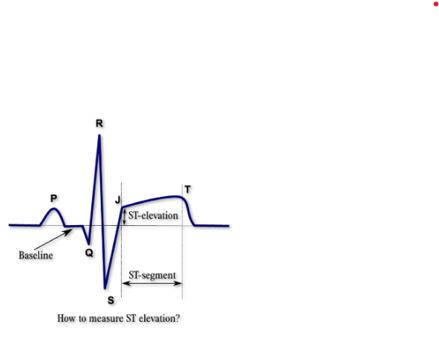 <p>S and T is elevated on the ECG, J point is elevated</p><p>Pain and breathlessness</p><p>Increased troponin levels</p>