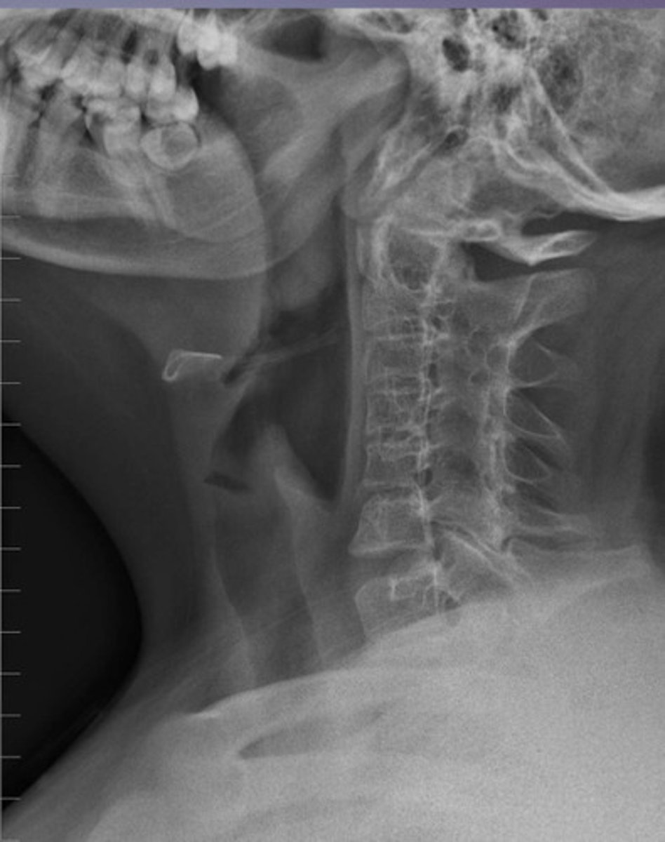 <p>Hypoplastic bodies and ankylosed facets indicate what condition?</p>
