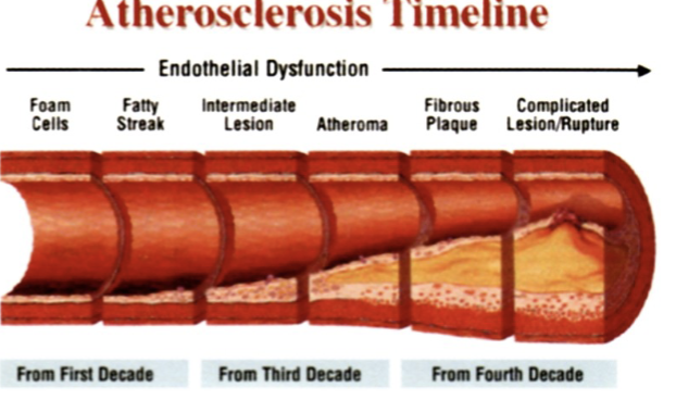 <ul><li><p>diet rich in saturated or trans fats</p><ul><li><p>contribute to cardiovascular disease</p><ul><li><p>atherosclerosis</p><ul><li><p>deposits called plaques develop in walls of blood vessels, causing inward bulges that impede blood flow and reduce resilience of vessels</p></li></ul></li></ul></li></ul></li></ul>