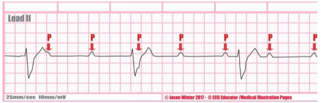 <p>type of abnormality + characteristics?</p>