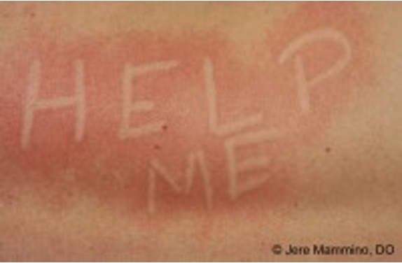 <p>“writing on the skin”; very common localized hive reaction</p>