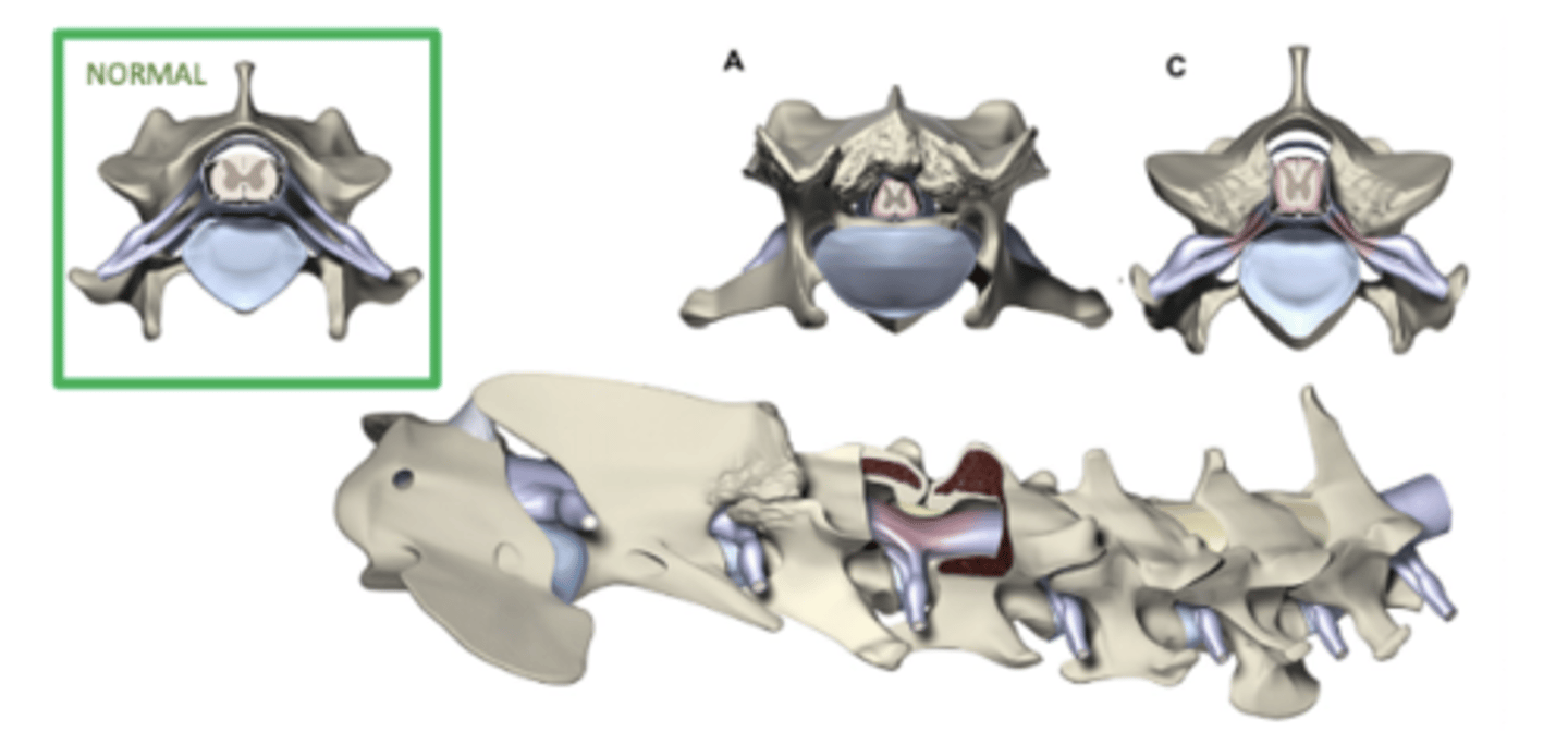 <p>- Spinal canal is more square/rectangular in shape or even hourglass -> Lateral aspect of spinal cord is pinched -> Ataxia</p><p>- As patients age, they start getting facet OA -> Dorsolateral pressure on spinal cord -> Proprioceptive tract pressure -> More ataxia</p>