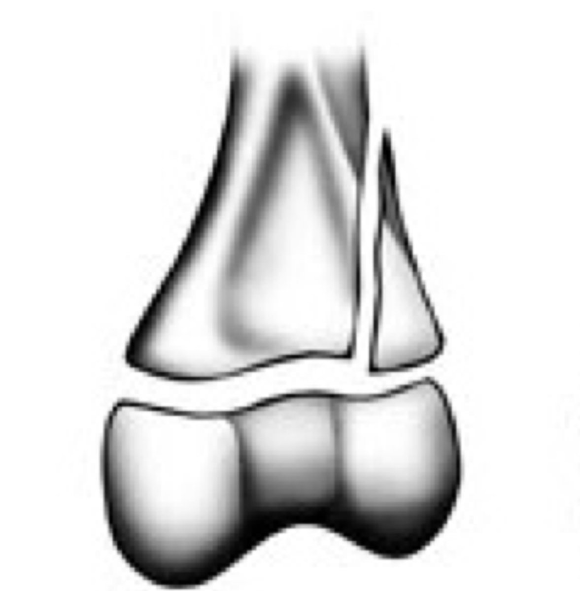 <p>Grade the Salter-Harris fracture?</p>