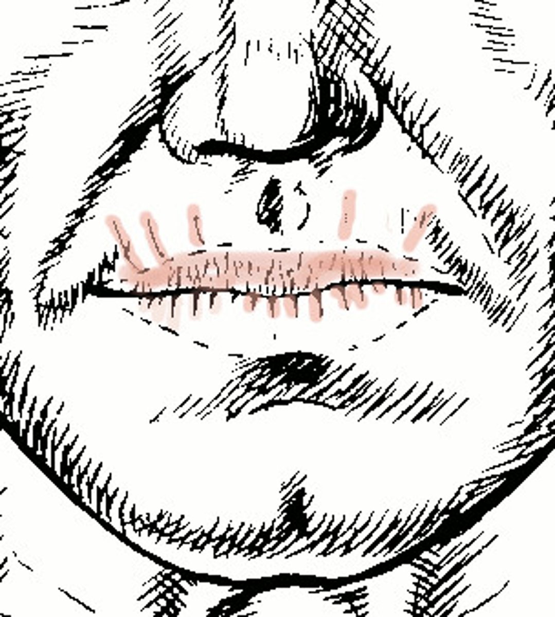 <p>wrinkles that radiate from the mucous membranes of the lips; acquired</p>