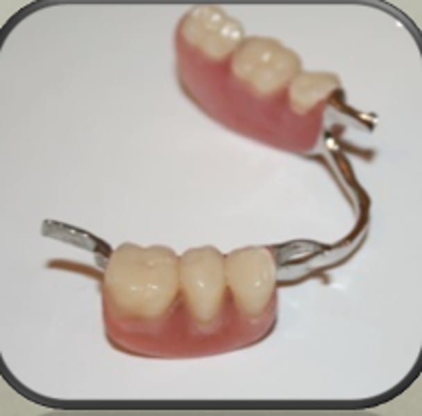 <p>Removeable prothesis that replaces only a few teeth in the dentition.</p>