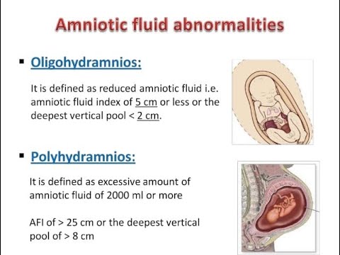 <p><strong>Oligohydramnios</strong> is <strong>too little amniotic fluid</strong>, caused by: </p><ul><li><p><strong>Placental insufficiency</strong>, <strong>lack of fetal urine</strong>, or <strong>rupture</strong> of the <strong>amniochorionic membrane</strong></p></li><li><p>It may lead to <strong>fetal compression</strong> (causing <strong>developmental problems</strong>) or <strong>compression of the umbilical cord</strong>.</p></li></ul><p></p>