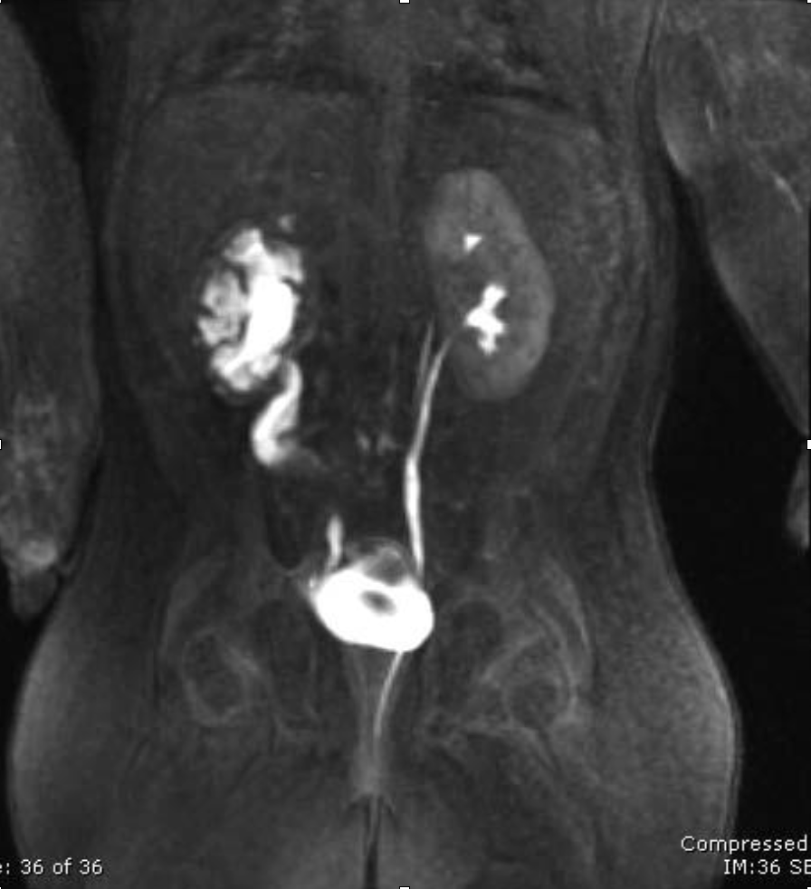 <p>Which imaging is used to visualize <strong>ureteral</strong> <strong>stricture</strong>?</p>