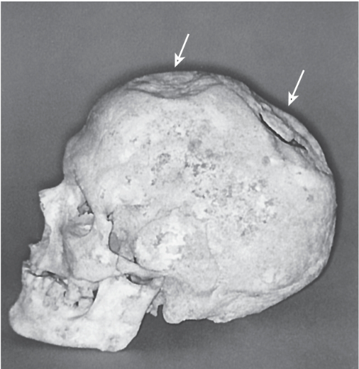 <p>an ancient surgical procedure involving drilling or scraping a hole through the human skull to expose the brain’s surface, there is evidence of this over 7000 years ago</p>