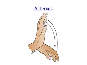 <p>ammonia levels build in brain</p><ol><li><p><span style="color: rgb(243, 116, 116);"><strong>stupor</strong></span></p></li><li><p><span style="color: rgb(189, 115, 12);"><strong>confused</strong></span></p></li><li><p><span style="color: rgb(113, 159, 10);"><strong>asterixis </strong></span>(hand flapping)</p></li><li><p>fruity, musty&nbsp;“<span style="color: rgb(127, 118, 234);"><strong>liver breath</strong></span>” (aka fetor hepaticus)</p></li></ol><p></p>