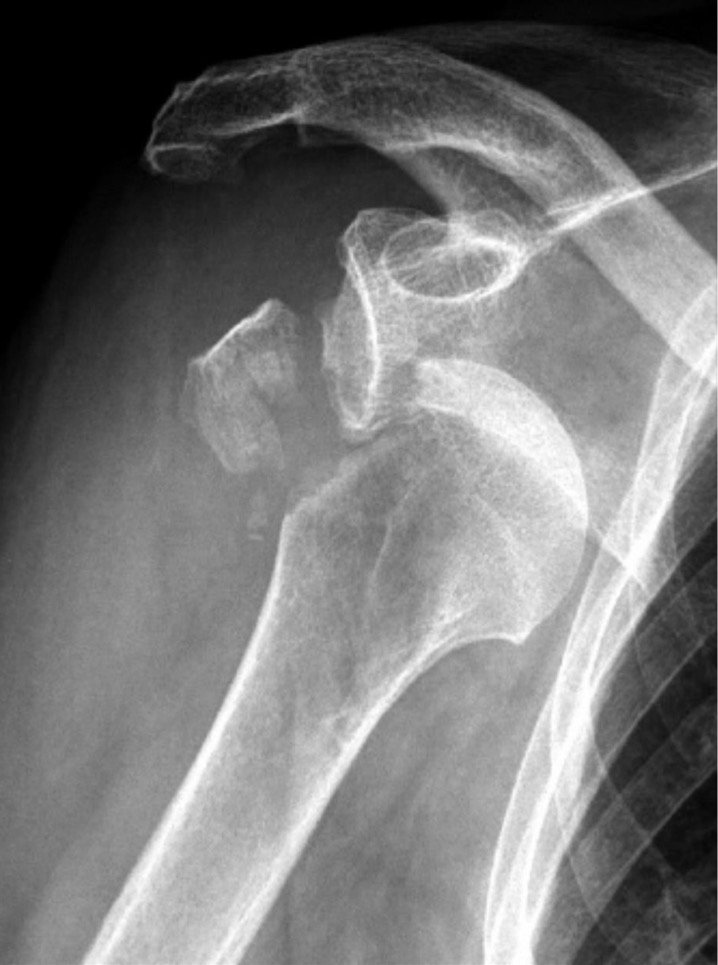 what is articular extension?