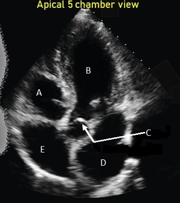 <p>MATCH APICAL 5 CHAMBER VIEW</p>