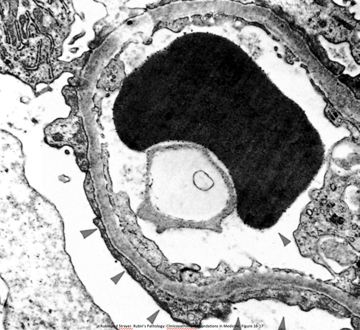 <p>What is indicated at the arrows? What disease does it indicate?</p>