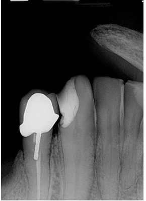 <p>What is the problem with this Phalangioma X-ray?</p>