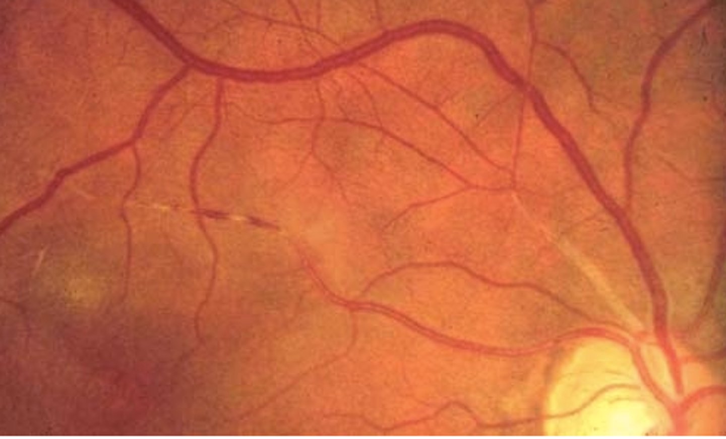 <p>Retinal arteries develop increased light reflex w/ bright coppery luster. Become full &amp; torturous; associated with fatty deposit, often found in conjunction with hypertension</p>