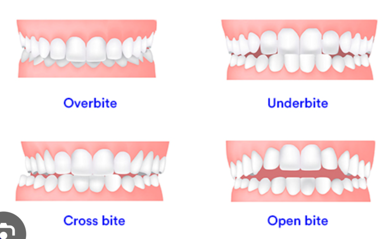 <p>Observation</p><ul><li><p><strong>Underbite</strong>: Mandibular teeth are in buccoversion (anterior to maxillary teeth), either unilaterally, bilaterally, or in pairs.</p></li><li><p><strong>Overbite</strong>: Maxillary incisors extend below mandibular incisors when the jaw is in centric occlusion</p></li><li><p><strong>Normal overbite</strong>: 1 to 2 mm, with upper teeth slightly ahead of lower teeth due to the longer maxillary arch..</p></li></ul><p></p>