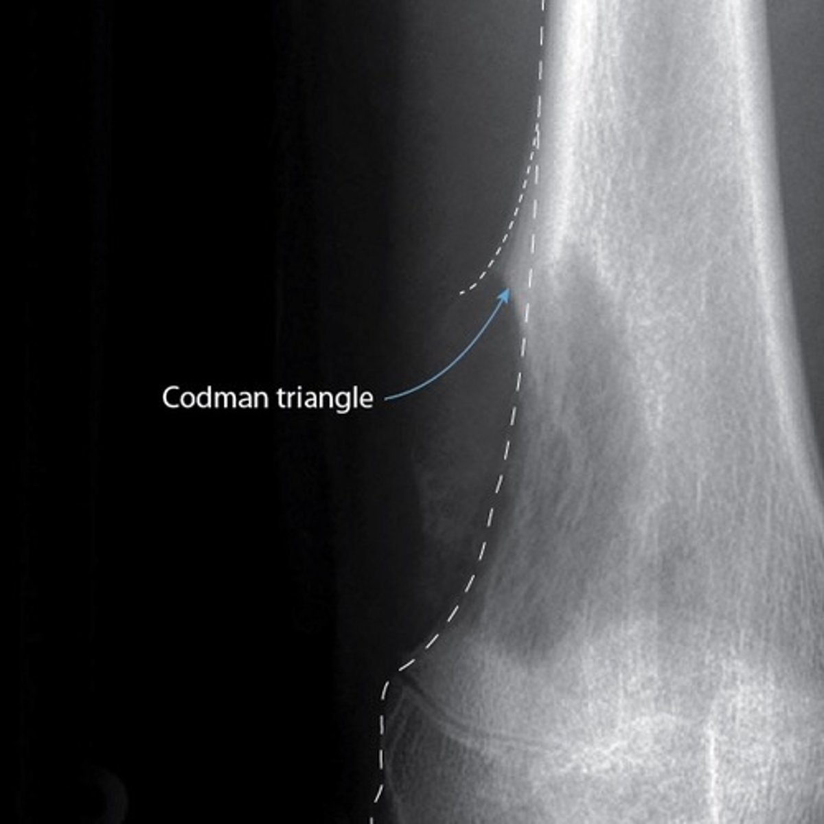 <p>osteosarcoma</p><p>also "codmans triangle" and periosteal rxn on XR</p>