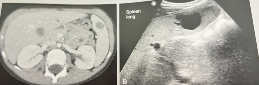 <p>A 22 year old man w/hx of multiple sclerosis and neurogenic bladder has undergone multiple CT scans and sonograms over the years. This image demonstrates a solitary splenic lesion that has been stable in size and appearance across the pt’s imaging hx. What is the most likely nature of this finding?</p>