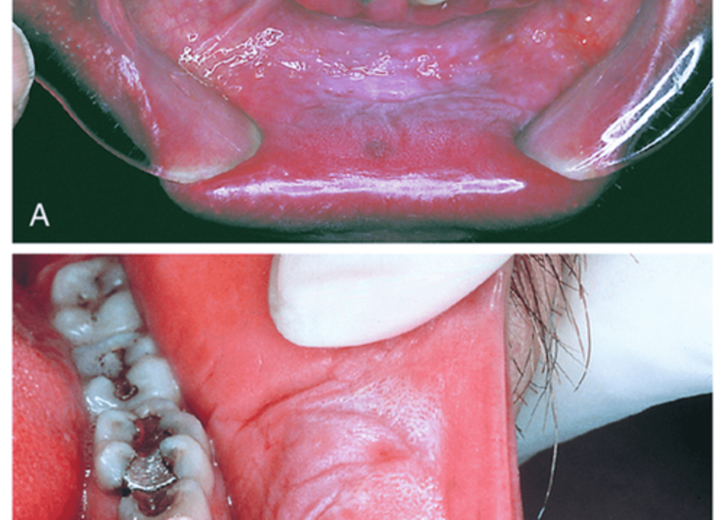 <p>White lesion located where chewing tobacco is placed, most often in the mucobuccal fold</p>
