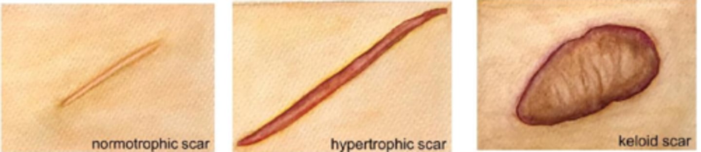 <p>hypertrophic scar = improve with surgery</p><p>keloid = often worsened by surgery</p>