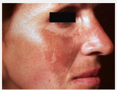 <ul><li><p><strong>Acquired hyperpigmentation</strong> on <strong>sun-exposed areas</strong>, especially the face.</p></li><li><p>Common in <strong>women with darker skin tones</strong>.</p></li><li><p>Triggered by <strong>UV light</strong> and <strong>increased estrogen</strong> (pregnancy, OCP use).</p></li><li><p>Leads to <strong>↑ melanin synthesis</strong> in susceptible individuals.</p></li></ul><p></p>