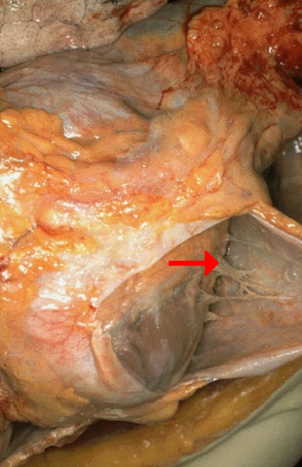 <ol><li><p>Fibrinous Inflammation</p></li><li><p>Fibrin</p></li><li><p>Effusion (in pericardial cavity)</p></li><li><p>Exudate (protein-rich)</p></li></ol><p></p>