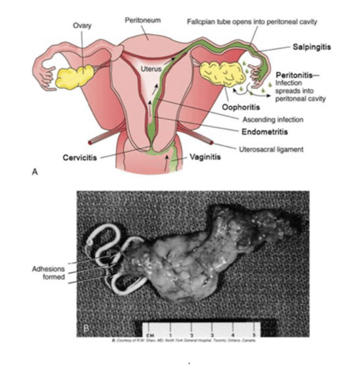 <p>infection of uterus, fallopian tubes and/or ovaries. can be acute or chronic. infection originates as an ascending infection from the lower reproductive tract that can occur due to bacteremia. most infections arise from STDs, nonsterile abortions, or childbirth</p>