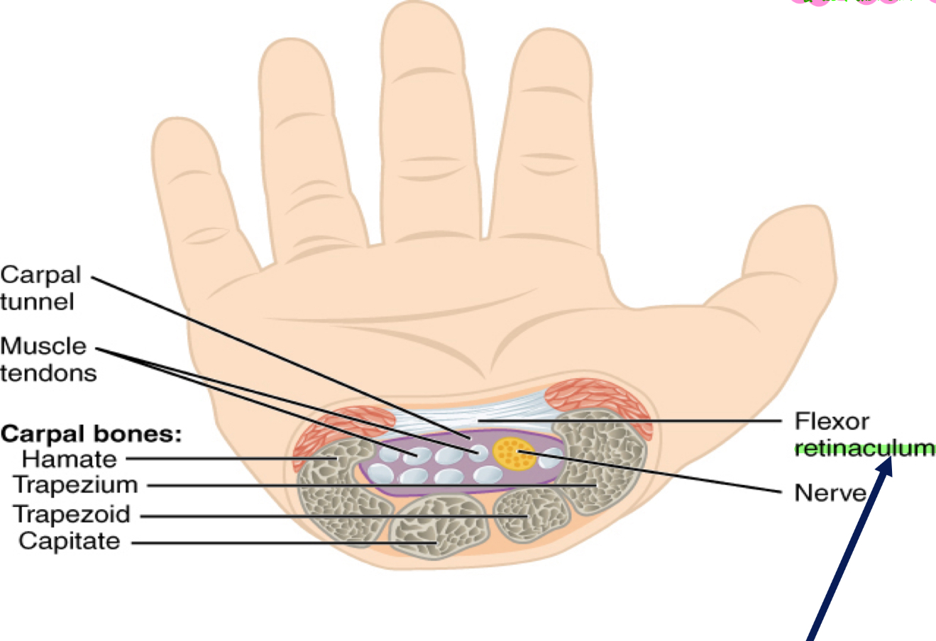 <ul><li><p>CPL had it and the chiropractor fixed it</p></li><li><p>Put several electrodes on forearm to highest setting&nbsp;</p></li><li><p>Muscles contract… was trying to fatigue muscles of forearm and put less pressure on MEDIAN nerve&nbsp;</p></li><li><p>When fatigue was over, was trying to maybe get some of those muscles to rearrange themselves in a way that didn’t continue to put pressure on nerve </p></li><li><p>**<strong><em>Retinaculum</em></strong> = Band of thickened deep <strong><em><u>fascia</u></em></strong> usually around tendons&nbsp;</p></li></ul><p></p>