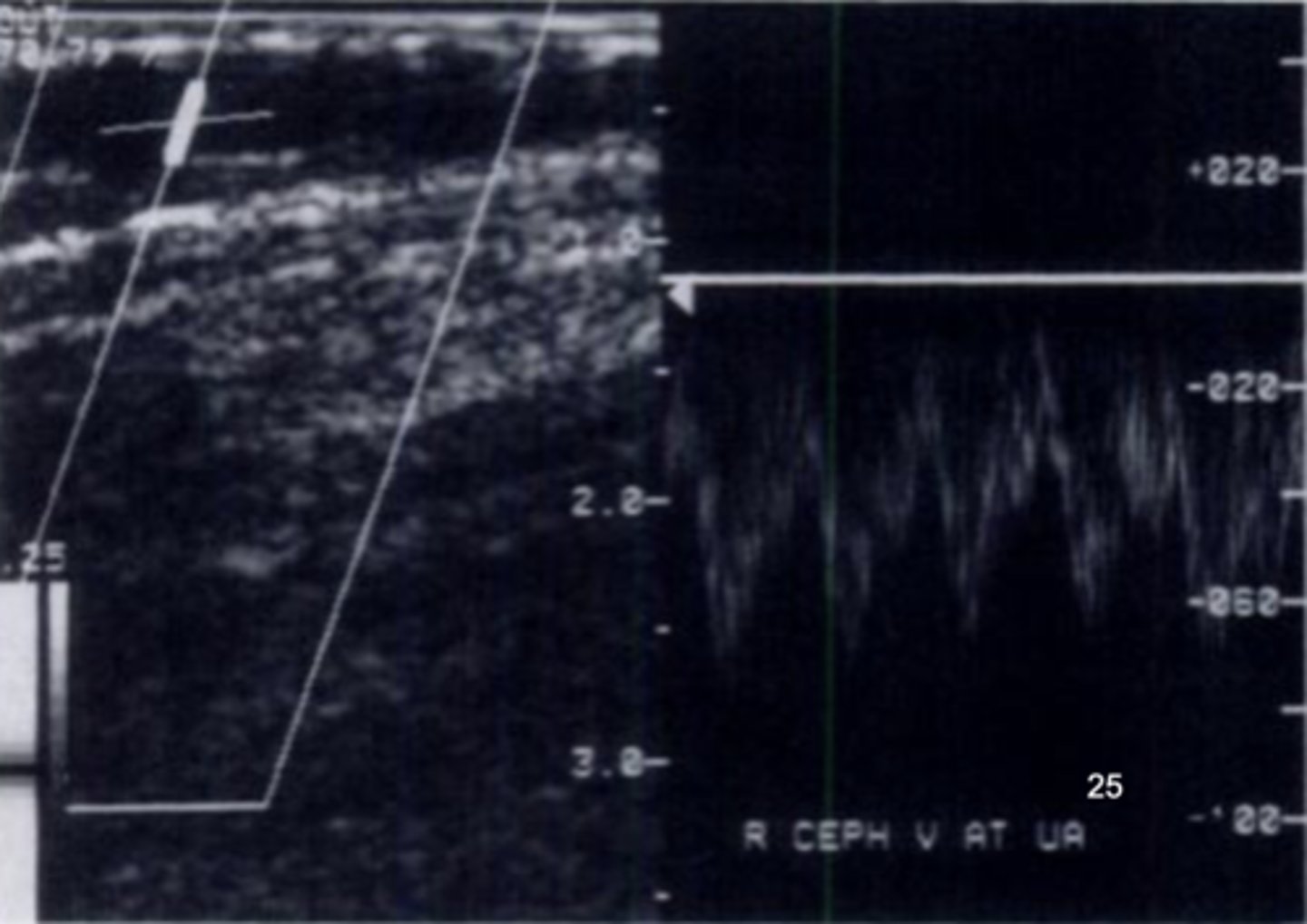 <p>High flow volume</p><p>Pulsatile prox to anastomosis</p>