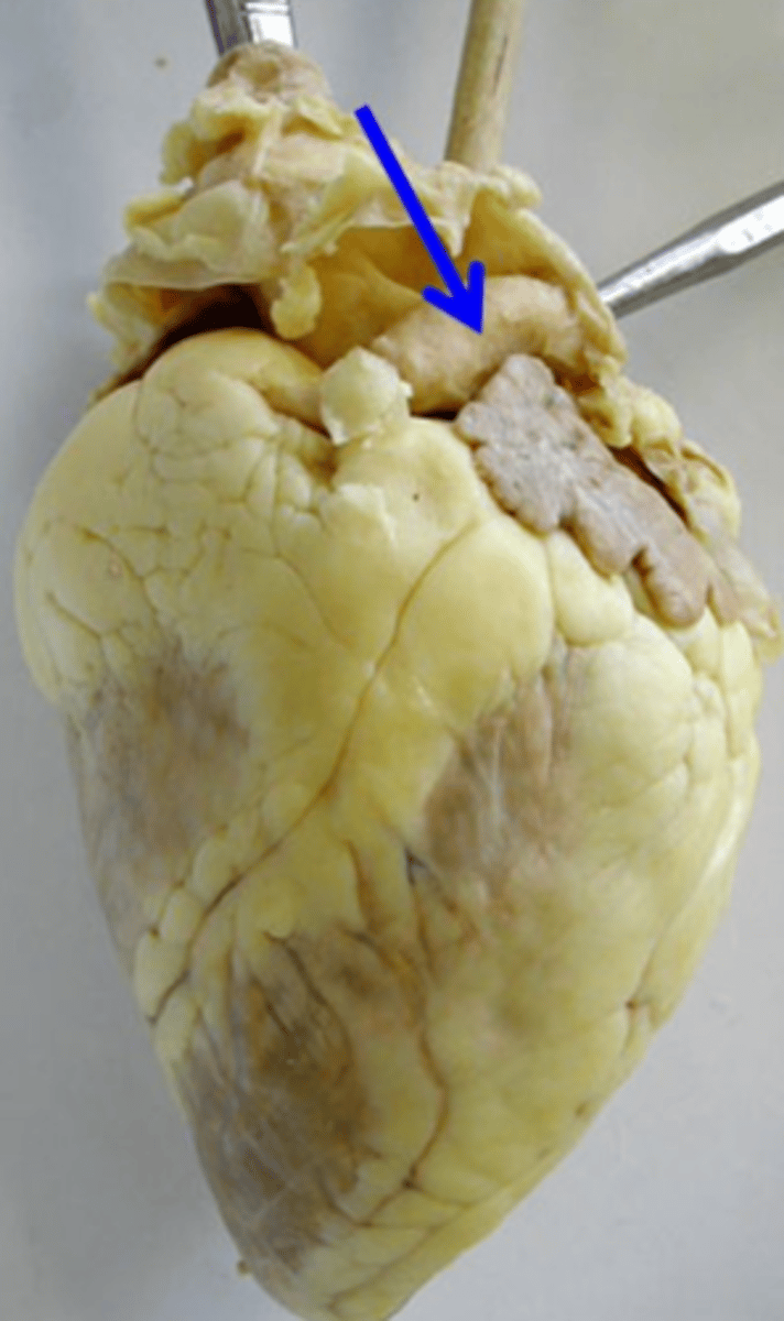 <p>blood vessel that transports blood away from the heart to the lungs</p>