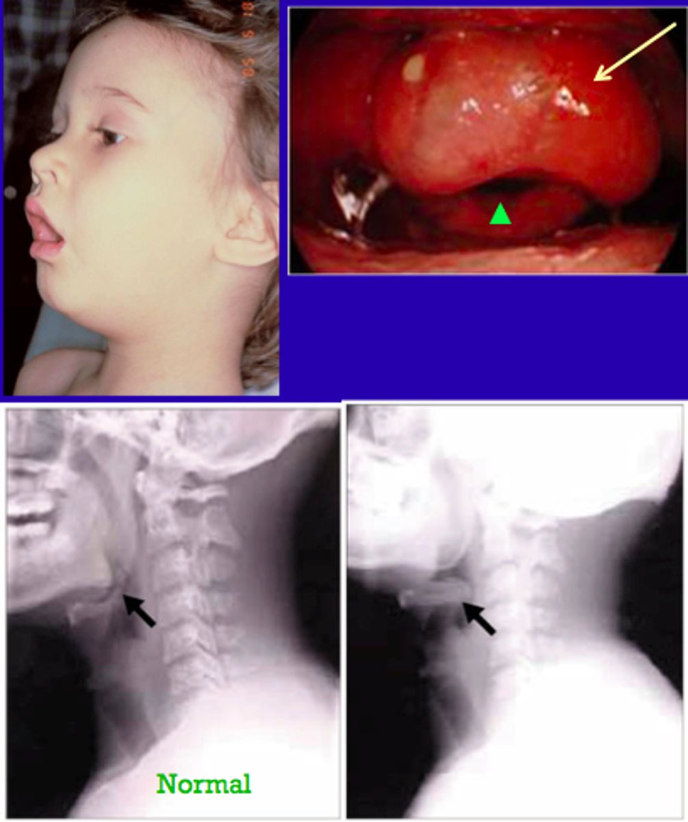 <p>severe, life-threatening infection of the epiglottis and supraglottic structures that occurs most commonly in children between 2 and 12 years of age</p>