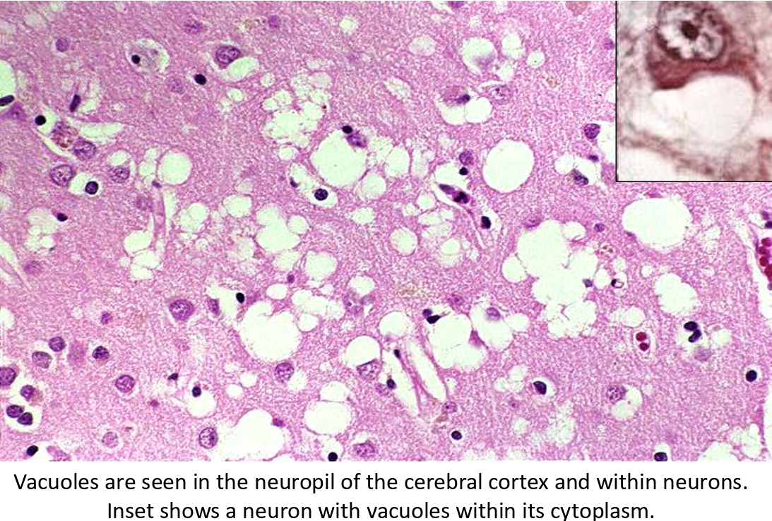 <p>Infectious prion disease causing rapid onset of fatal dementia</p><p><u>Pathogenesis</u>:</p><ol><li><p>Spontaneous conformational change from normal to abnormal prion protein</p></li><li><p>Prions bind to other normal prions which progressively reproduc and form aggregates</p></li></ol><p></p><p><u>Sources of infection:</u></p><ul><li><p>Contaminated corneal transplants</p></li><li><p>Dura mater grafts</p></li><li><p>Human growth hormone</p></li></ul><p></p><p><u>Signs</u>:</p><ul><li><p>Onset 50-75 yrs</p></li><li><p>Rapidly progressing dementia with myoclonus</p></li><li><p>Biopsy shows spongiform transformation of cortex</p></li></ul><p></p>