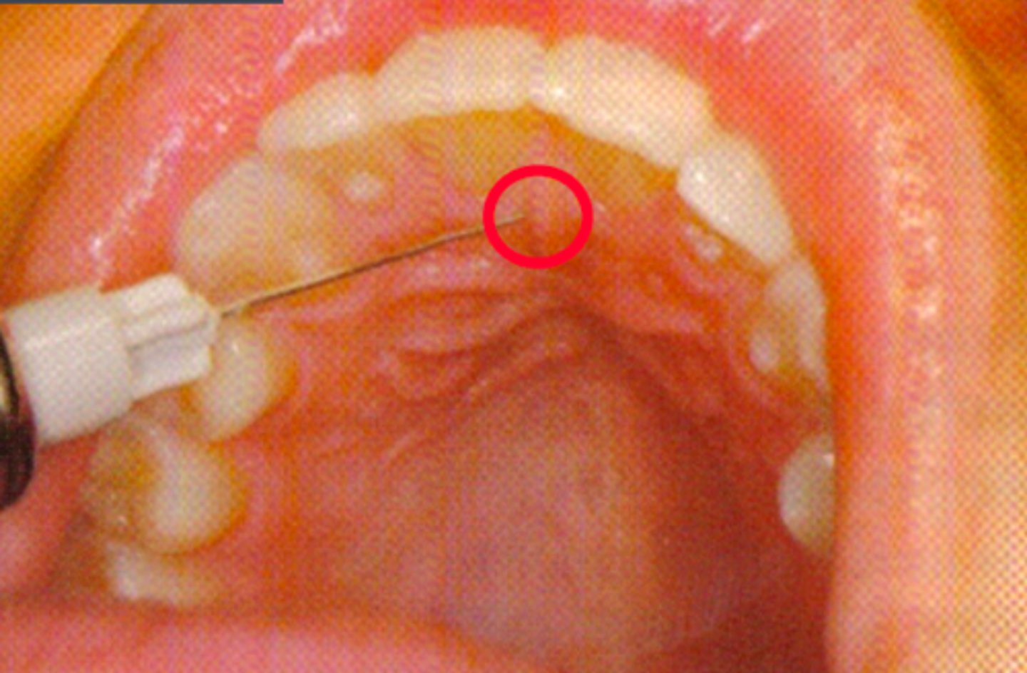 <p>ID the anesthesia technique:</p>