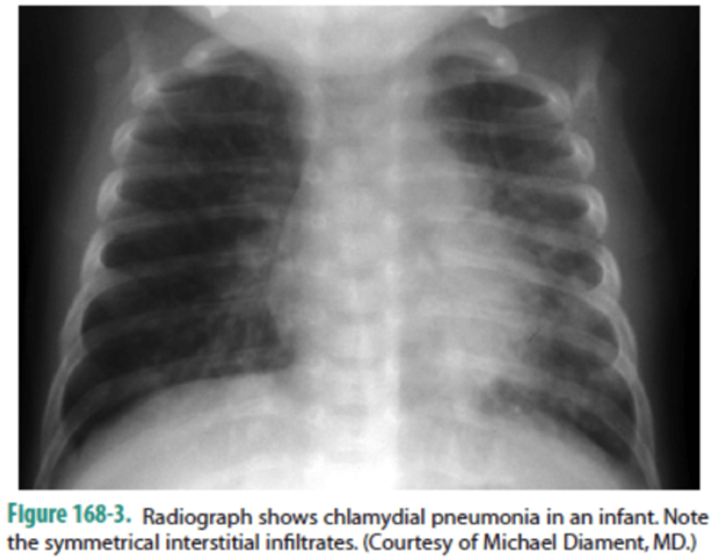 <p>notice the "shaggy" heart borders w/ an overall "dirty" appearance to the lung fields</p>