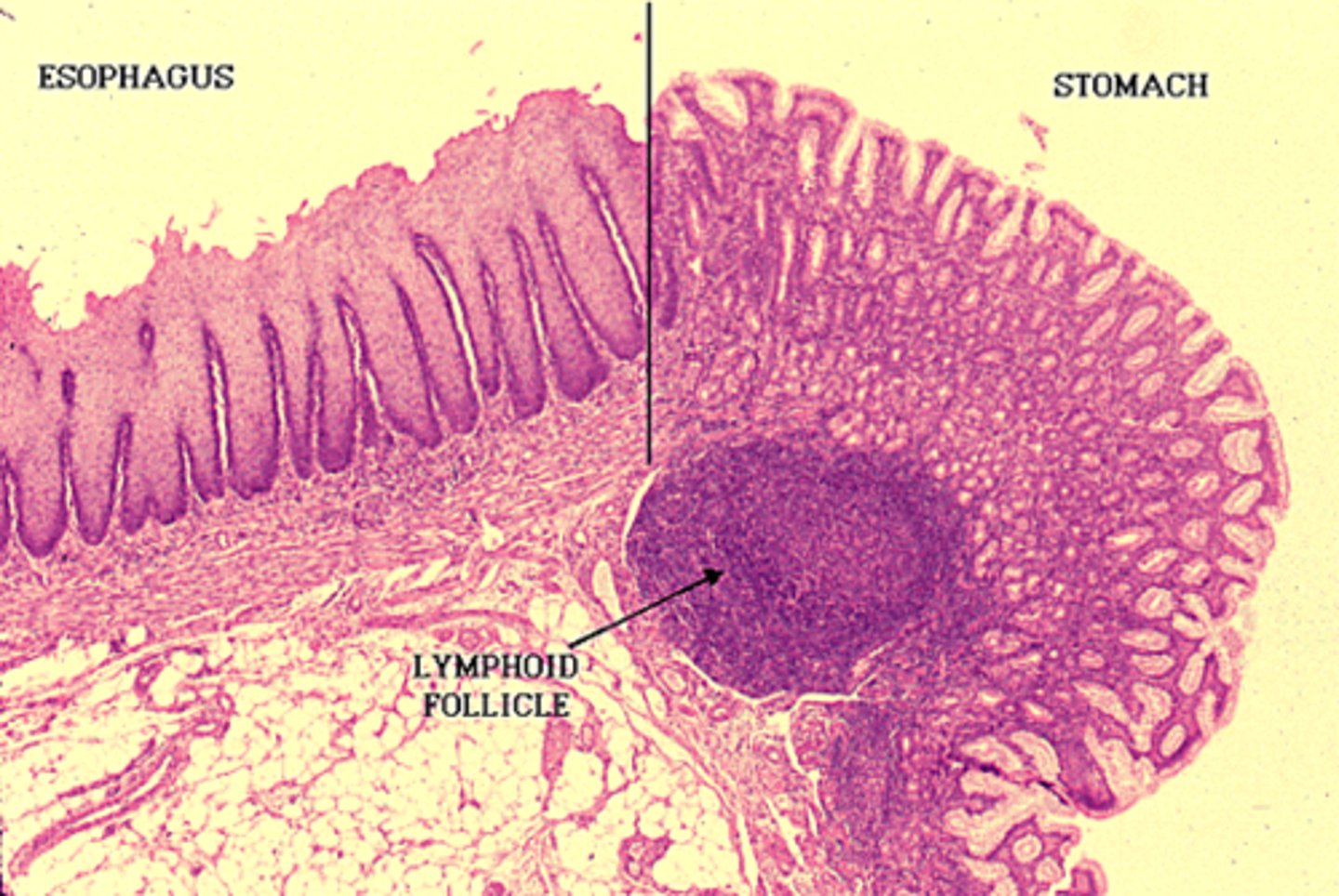 <p>the gastroesophageal junction is demarcated by a transition from one epithelial type to another epithelial type</p><p>• some people are predisposed to esophageal ulceration w/ increased risk of adenocarcinoma if their junction is at the lower one-third of the esophagus instead </p>