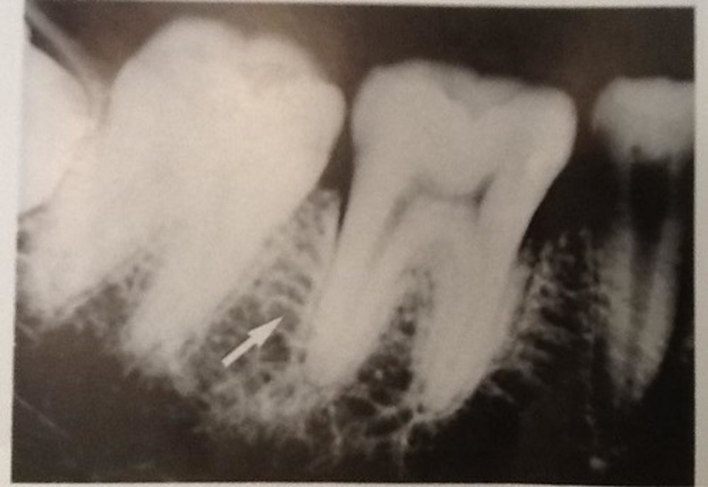 <p>Appears less radiopaque than cortical bone; less dense</p>