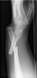 <p>Radial shaft fracture and a dorsal (posterior) dislocation of the ulna at the wrist</p>