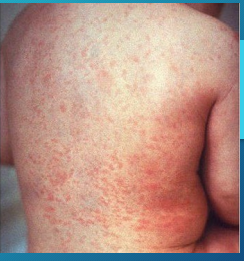 <p><strong>Rubella (German Measles)</strong></p><p>-Etiology → __________ family </p><p>-Symptoms </p><ul><li><p>Mild prodromal phase (may go unnoticed) </p></li><li><p>Postauricular, posterior cervical, occipital _____________</p></li><li><p>Erythematous, _____________ rash that begins on ____ and spread to ____. Lasts about 3 days </p></li><li><p>Forscheimer spots → rose colored spots on ____ _______ </p></li></ul><p>-Diagnosis </p><ul><li><p>___ antibodies (positive 5 days after symptoms onset) </p></li></ul><p>-Treatment </p><ul><li><p>Supportive care</p></li><li><p>MMR vaccine for prevention </p></li></ul><p>-Complications </p><ul><li><p>Greatest risk to ____ _________ due to congenital rubella syndrome </p></li></ul><p></p>