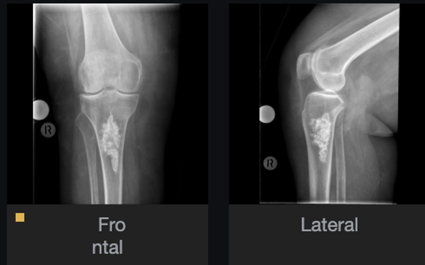 <p>Most likely diagnosis?</p>