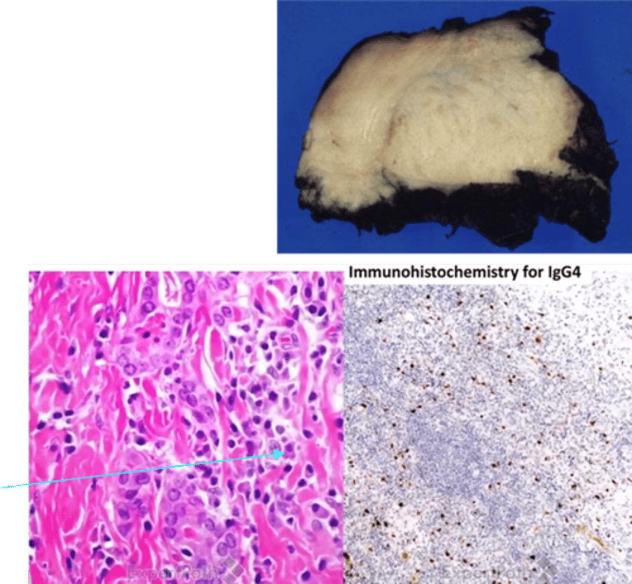 <p>Define Condition:</p><p>Invasive fibrous thyroiditis</p><p>-Path: IgG4 related disease</p><p>&gt; IgG4-producing plasma cells and lymphocytes</p><p>&gt; Fibrosis and complete/partial obstruction of medium sized veins</p><p>&gt; Hypothyroidism ONLY in 1/3 pts</p><p>-Sx/PE:</p><p>&gt; Hard, fixed, NONTENDER, thyroid</p><p>-Dx:</p><p>&gt; Gross =</p><p>&gt;&gt; "ROCK HARD" fixed thyroid mass adherent to surrounding tissues --&gt; mimics malignancy</p><p>&gt;&gt; Cut surface = Tan/gray, WOODY, avascular</p><p>&gt; Micro =</p><p>&gt;&gt; Dense, thick fibrosis --&gt;&nbsp;replacing normal thyroid tissue</p><p>&gt;&gt; Marked lymphoplasmacytic infiltrate</p><p>-Tx:</p><p>-Prog: Fibrosis extending to local structures (trachea, esophagus) --&gt; MIMICS ANAPLASTiC CARCINOMA</p>