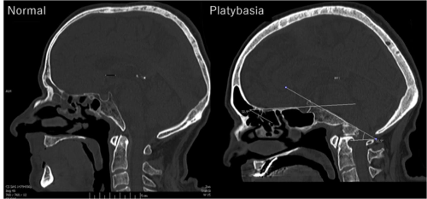 <p>flat skull</p>